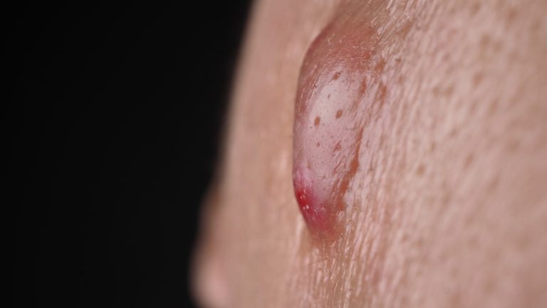 Comment faire mûrir un furoncle sans avoir mal ? - Triplel Le Mag